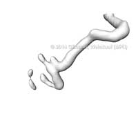 aneurism_subregion_gauss2